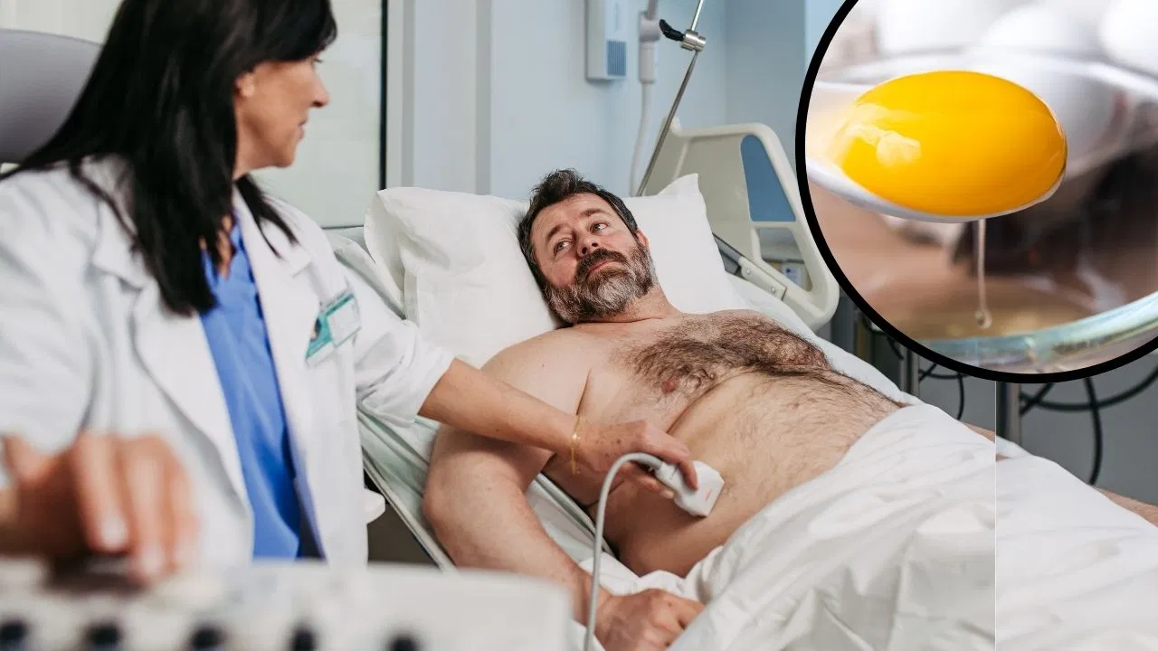 फैटी लिवर के मरीजों के लिए अंडा ‘वरदान’ है या ‘विलेन’? अंडे का पीला भाग खाने से पहले जान लें ये जरूरी नियम