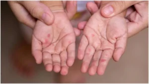 Satna Measles Outbreak: सतना शहर में पैर पसार रहा खसरा; राजेंद्र नगर में मिले कई मरीज, स्वास्थ्य विभाग में हड़कंप