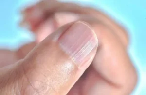 Black Line on Nails: नाखूनों पर दिखने वाली काली लाइन को न करें इग्नोर, हो सकता है स्किन कैंसर का संकेत