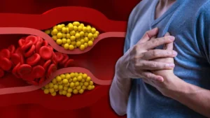Bad Cholesterol Causes: बैड कोलेस्ट्रॉल को न समझें मामूली, ये 5 आदतें बना सकती हैं आपको दिल का मरीज; एक्सपर्ट से जानें बचाव